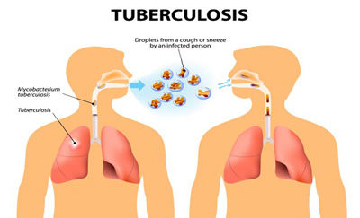 TB Is A Cause For Watchfulness, Not Alarm