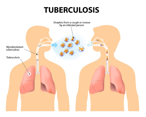 Fight TB: Know The Signs And Symptoms - Hmong Times